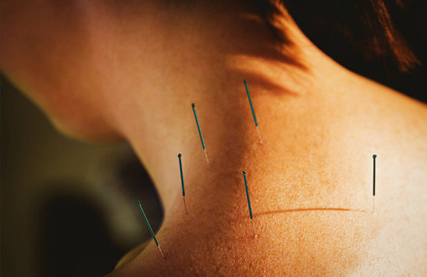 Acupuncture